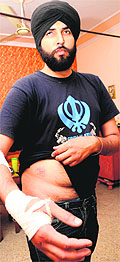Gurmail Singh shows his wounds at his house in Sector 35 of Chandigarh on Sunday