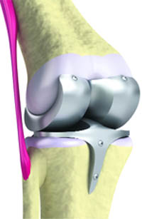Biomedical engineers have contributed a lot to developing better artificial joints