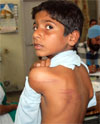 The child showing his bruises.