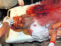 One of the injured persons in a hospital