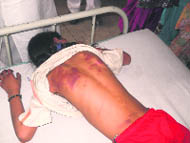 The victim, Simran, who sustained back injuries after her teacher beat her up, admitted at the Civil Hospital in Samrala on Friday. 
