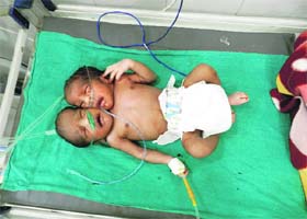 The baby having two heads at a hospital in Muktsar