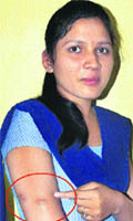 Victim Nidhi Poshan shows a monkey bite. 