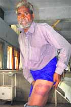 Munni Lal  undergo treatment at the Civil Hospital in Jalandhar.