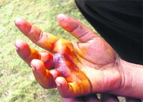 The injured hand of the girl thrashed by a government school teacher