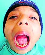 The patient, Himanshu, after the surgery of his face at the PGIDS, Rohtak