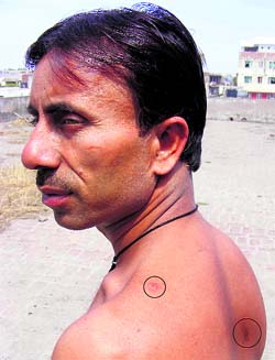 Ajay Kumar shows the bullet wounds sustained while chasing armed snatchers