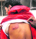 A youth shows an injury on his back at a hospital in Jagraon. A Tribune photograph