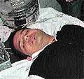 Injured Harphool Pathak at the Government Rajindra Hospital in Patiala on Tuesday