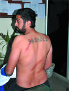 Prabhjot Singh shows his injuries during a medical examination at the Civil Hospital on Saturday. 