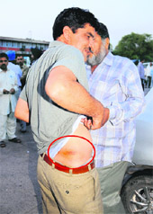 Rajesh, CTU bus driver, shows an injury mark.