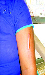 The woman shows an injury mark inflicted by her husband at Sirsa