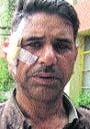 Hira Lal of Batahar village at a hospital in Manali on Sunday. Photo: MC Thakur