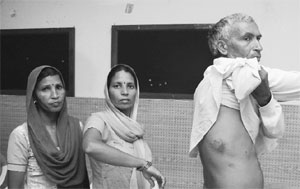 A Maruti worker, who was injured in a lathicharge in Kaithal on May 19, shows his injury marks at a press conference in Chandigarh on Tuesday. 