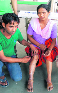 Chhindo shows the burns she received in the LPG cylinder blast at Maqboolpura in Amritsar on Tuesday.