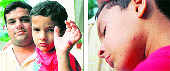 The four-year-old boy who was bitten by a stray dog at Rani ka Bag area in Amritsar on Wednesday
