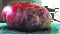 The 18-kg ovarian tumour removed from a woman patient at the PGIMS, Rohtak, on Sunday. Tribune photo
