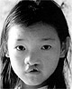 A child with cleft lip; and (right) Pinki after surgery