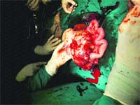 The five-kg tumour removed at the medical college in Khanpur Kalan on Friday