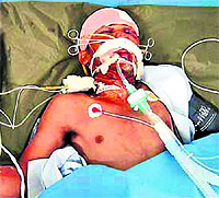 Varinder Kumar, a railway employee, who was attacked and injured by residents involved in a theekri pehra in Fatehgarh Churian, recuperates at a hospital in Amritsar