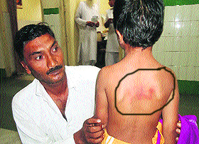 An injury mark on the students back.