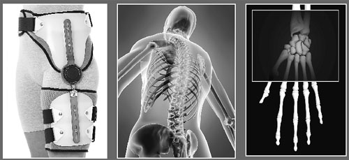 The annual incidence rate of osteoporotic fractures of back bone, wrist and hip is growing rapidly.