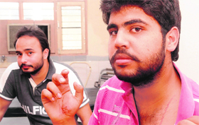 The engineering student shows his injury marks in Mohali.