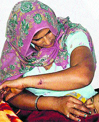 The robbed woman shows her injury at Balhera village of Karnal on Sunday