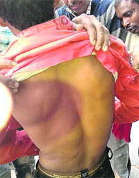 Pankaj shows injuries on his back.