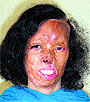 Suman Kaushal, whose scarred face is a reminder of the fire tragedy that took place 18 years ago at Dabwali in Sirsa