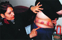 A woman shows the injuries suffered by the victim in Sector 2, Panchkula, on Monday. Tribune photo: Nitin Mittal
