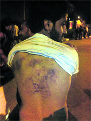 Ramanpreet Singh of the SFS, who was arrested two days ago on the PU campus, shows his injury marks allegedly inflicted on him by policemen at the Sector 11 police station.