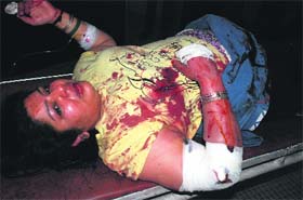 The victim, Radhika Mittal, under treatment at the GMSH, Sector 16, Chandigarh, on Wednesday
