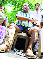 Another resident who suffered injuries on his fractured leg during the lathicharge
