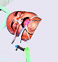 Head constable Kuldeep Kumar under treatment at a private hospital in Panchkula on Thursday