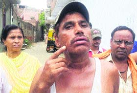 A resident shows his swollen face due to a skin infection in the Gandhi Camp area in Jalandhar