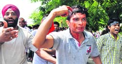 One of the teachers who was injured in the lathicharge. Tribune photo: Manoj Mahajan