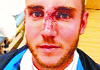 Stuart Broad posted his picture on Twitter. He was hit on the nose by a Varun Aaron delivery