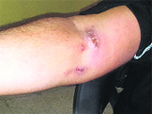A heroin addict at the Civil Hospital shows injection marks on his arms. He revealed that unable to purchase heroin because of its high cost, he mixes it with water and injects it into his blood.